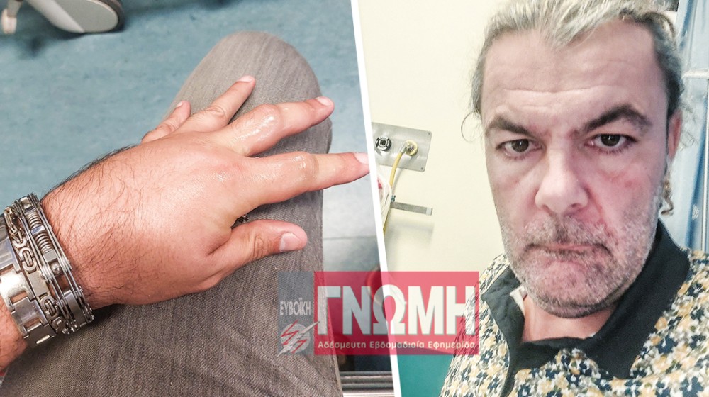 ΜΠΑΜΠΗΣ ΓΚΑΡΟΥΤΣΟΣ: Ξεροστάλιασε στα επείγοντα μετά από τσίμπημα μέλισσας