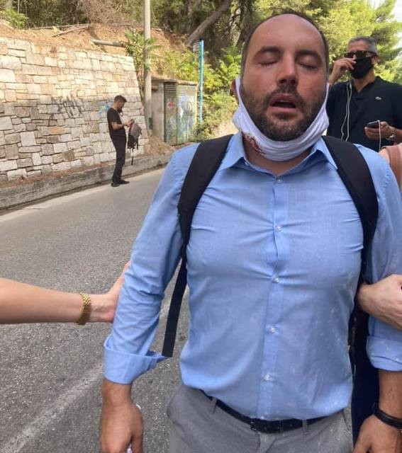 Στο Νοσοκομείο με έγκαυμα στο μάτι ο βουλευτής Μίλτος Χατζηγιαννάκης